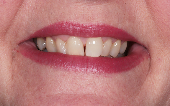 invisalign and Bonding before after