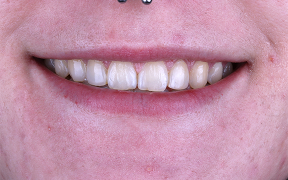 invisalign and Bonding before after