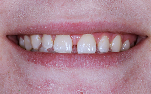 invisalign and Bonding before after