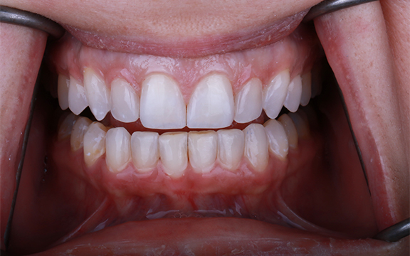 invisalign and Bonding before after