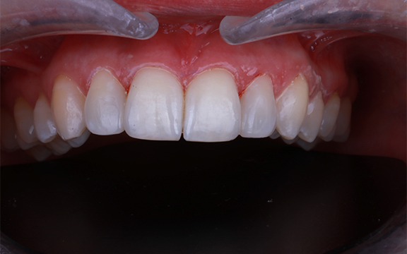 Resin bonding and reshaping before after