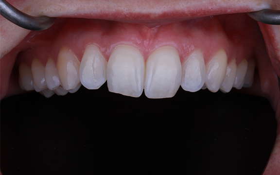 Resin bonding and reshaping before after