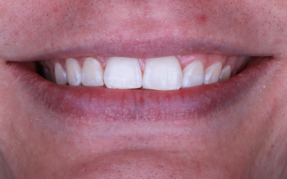 invisalign before after