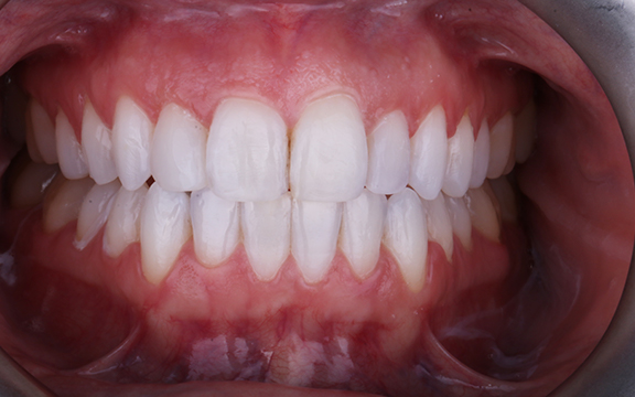 invisalign before after