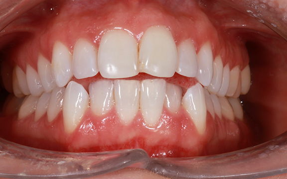 invisalign before after