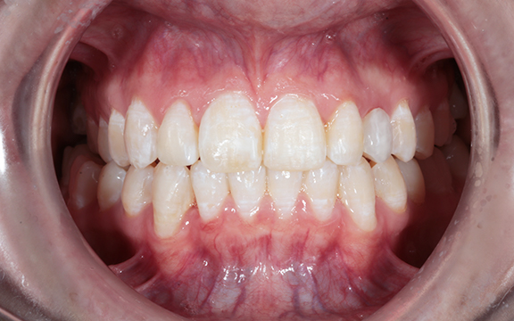 invisalign before after