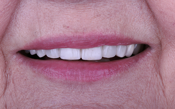 veneers before after